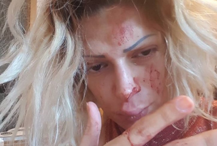 Srpska pevačica brutalno pretučena? (UZNEMIRUJUĆE FOTOGRAFIJE)