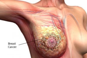 10 things about breast cancer s2 what is breast cancer