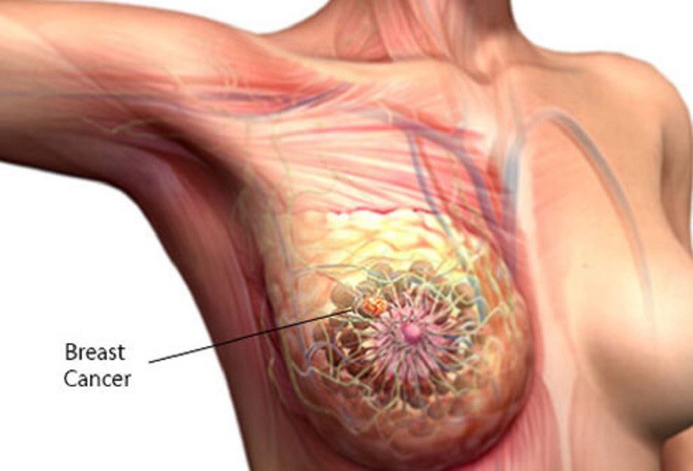10 things about breast cancer s2 what is breast cancer