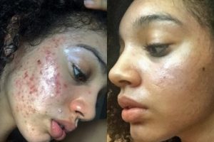 Za 30 dana očistila je svoje lice od akni i ožiljaka: Sada je otkrila kompletnu proceduru! (Video)