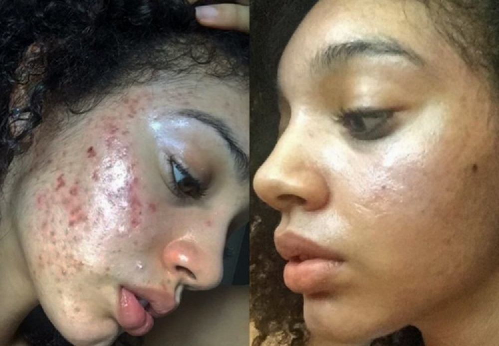 Za 30 dana očistila je svoje lice od akni i ožiljaka: Sada je otkrila kompletnu proceduru! (Video)